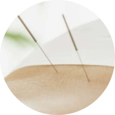 Acupuncture pins in lower back